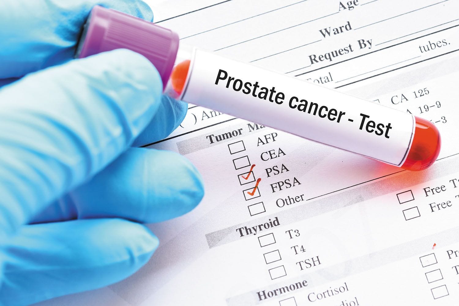 Is It Time to Remove 'Cancer' Label From Low-Risk Prostate Tumors? Is It Time to Remove 'Cancer' Label From Low-Risk Prostate Tumors?